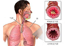 哮喘